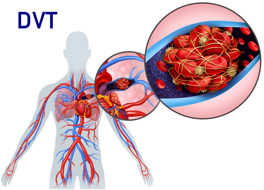 derin ven trombozu tedavisi